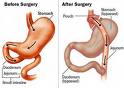 Roux-en-gastric bypass in India: An Overview