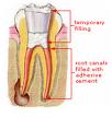 Root Canal Therapy:FAQ