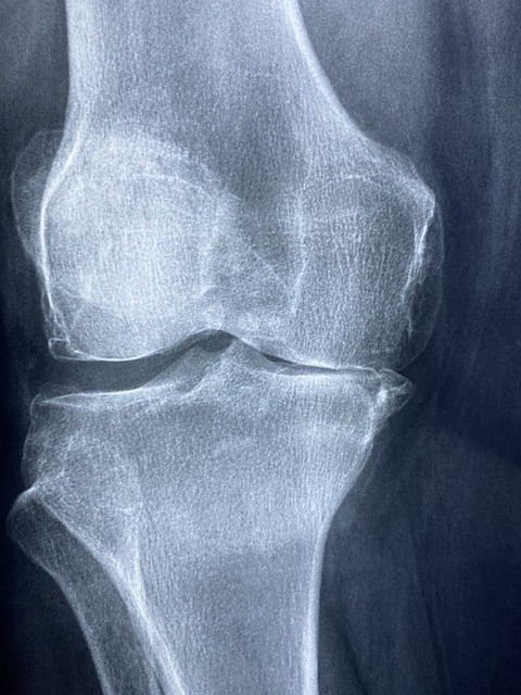 Knee X Rays Arthritis Skeleton  - Taokinesis / Pixabay